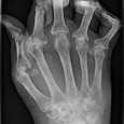 Dr. Koelker discusses treatment options for rheumatoid arthritis.  How to be your own doctor in 2012 and TEOTWAWKI / Armageddon.