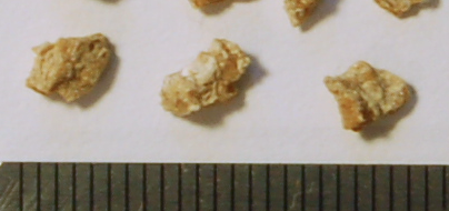 Kidney_stone_fragments1-404x190.png