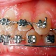 A reader has asked how to remove dental braces in case of emergency.  Is there a danger of fracturing a healthy tooth?  How can the clasps be removed?  What about...