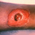 Medical Quarantine – Protecting Your Family from Infection Plague. Yellow fever. Cholera. Diphtheria. Diseases which evoke images of death and despair. Though less likely to transmit a fatal illness, would you open your door to someone with...