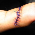 Suturing a Wound – Part V – the British Way There are as many ways to suture a wound as to sew a dress. While that may be a bit of an exaggeration, the point is, there is not a...