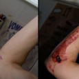 Suturing a Wound – Part III – Layered Closure In Part III Dr. Cady addresses a deeper, gaping wound, demonstrating how to perform a layered closure. This video offers a much better view of the tissues than is usually...