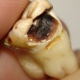 Protected: Wisdom Teeth – Advanced Treatment Options There is no excerpt because this is a protected post.