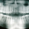 Welcome to the Wonderful World of Wizzys So what are we going to do about impacted wisdom teeth in a world without dentists? Not to put too fine a point...