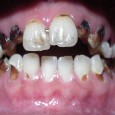 Abscessed Teeth – Where will they lead? Earlier today I was thinking about my patients who refuse to visit a dentist, for whatever reason. Now and then they see or call me about a toothache, requesting an...