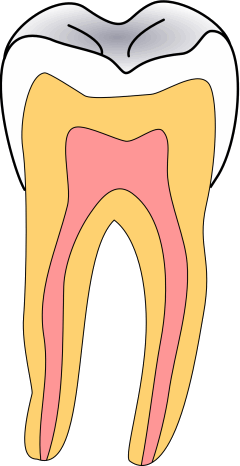Pit_and_fissure_caries