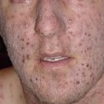 Photo Quiz Question – Q.003 – July 1, 2011 31-year-old white male, circa 1951, missionary to Nigeria Illness started with fever and aching for 2-3 days, followed by development of...