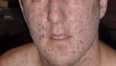 Photo Quiz Question – Q.003 – July 1, 2011 31-year-old white male, circa 1951, missionary to Nigeria Illness started with fever and aching for 2-3 days, followed by development of...