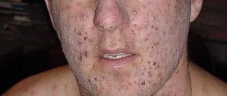Photo Quiz Question – Q.003 Photo Quiz Question – Q.003 – July 1, 2011 31-year-old white male, circa 1951, missionary to Nigeria Illness started with fever and aching for 2-3 days, followed by development of...