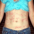 Photo Quiz Question – Q.002 – June 17, 2011 It’s summertime . . . better watch out for this problem. Anyone can get it – no one is truly immune....