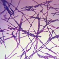 Photo Quiz Answer – Q.001 – June 10, 2011 Cutaneous anthrax due to Bacillus anthracis. Most cases of cutaneous anthrax are caused by contamination of an open wound, often with...