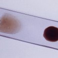 Clinical Laboratory Procedures under Austere Conditions: Part III – Sample Preparation The following post on clinical laboratory procedures is contributed by Pete Farmer, who holds advanced degrees in research biology and history, and is also an RN and EMT. For Part I of...