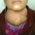 The following is excerpted from my upcoming book, Armageddon Medicine. Thyroid disease – Hypothyroidism (Low thyroid) The question of treating low thyroid in a post-apocalyptic world is a common one. ...