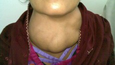 The following is excerpted from my upcoming book, Armageddon Medicine. Thyroid disease – Hypothyroidism (Low thyroid) The question of treating low thyroid in a post-apocalyptic world is a common one. ...