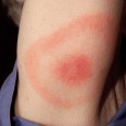 Photo Quiz Question – Q.004 Photo Quiz Question – Q.004 – August 5, 2011 23-year-old white male, who says he thinks he was stung by a bee while camping, but feels fine otherwise. What does...
