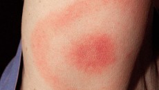 Photo Quiz Question – Q.004 – August 5, 2011 23-year-old white male, who says he thinks he was stung by a bee while camping, but feels fine otherwise. What does...
