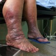 Photo Quiz Question – Q.005 – White female with black ankles Photo Quiz Question – Q.005 – September 08, 2011 65-year-old white female who consults you regarding her legs. What does the above image depict? Does it hurt? Why is one leg...