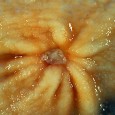 Making the most of OTC meds – ranitidine (Zantac) If you’ve ever seen a patient bleed out from an ulcer, you’ll recognize ranitidine as a potentially life-saving drug. The same could be said of other acid-reducing over-the-counter medications, including...