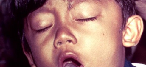 Say you have a bad cold.  It’s gone to your chest and now you’re coughing up green gunk. It’s also starting to hurt when you cough and you’re a little short...