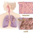 Tip of the Week: Primatene Mist Many preppers know about the benefits of Primatene Mist, the only OTC inhaler for asthma (and also useful for COPD and severe allergic reactions). Though doctors rarely recommend this medication...