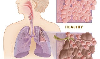 Tip of the Week: Primatene Mist Many preppers know about the benefits of Primatene Mist, the only OTC inhaler for asthma (and also useful for COPD and severe allergic reactions). Though doctors rarely recommend this medication...