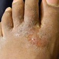 dry cracked feet athletes foot